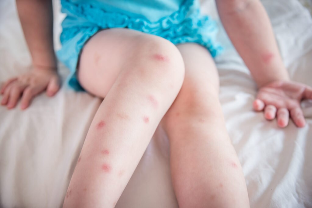 Symptoms of Bedbug Bites