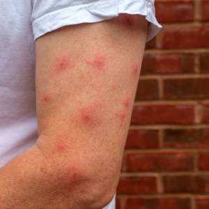 What Do Bedbug Bites Look Like?